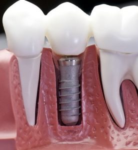 zubni implant