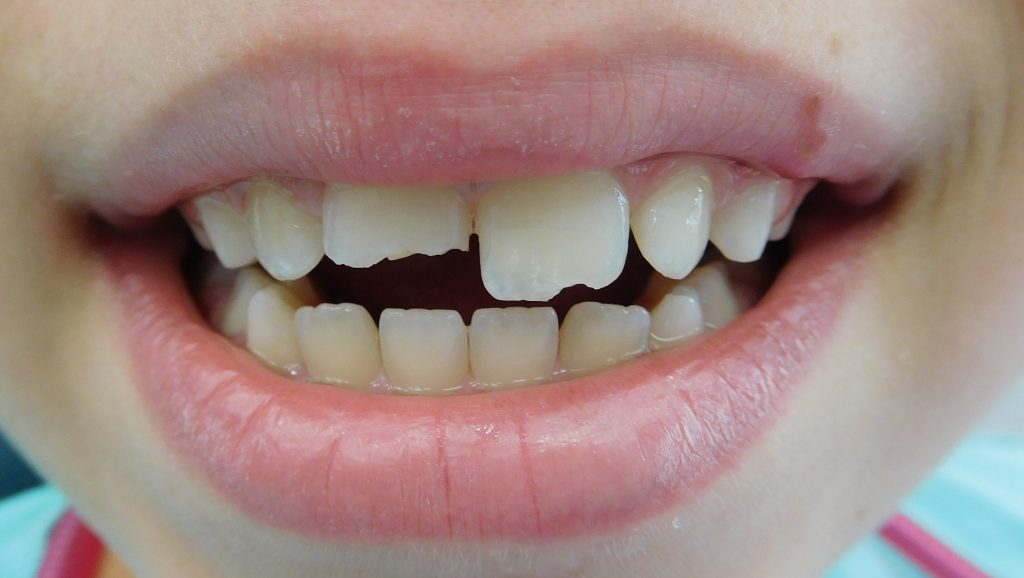Pokvareni zubi kod dece